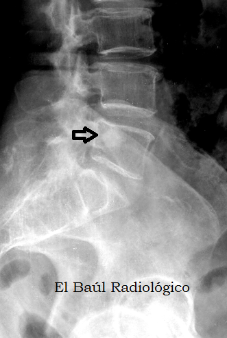 hemangioma oseo t12
